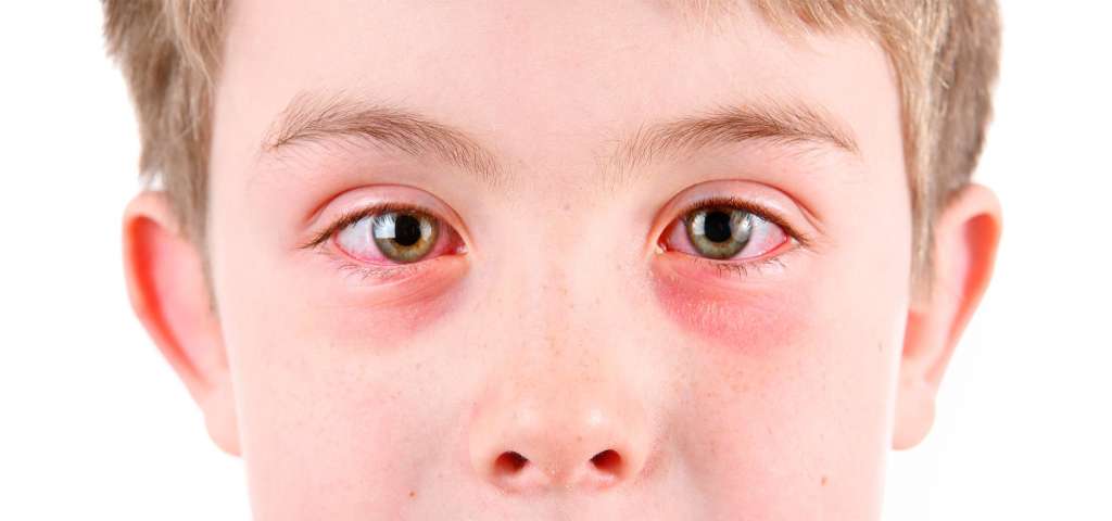 Лечение аллергического коньюктивита у детей и взрослых