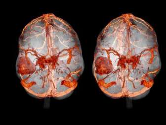 Метастазы в головной мозг